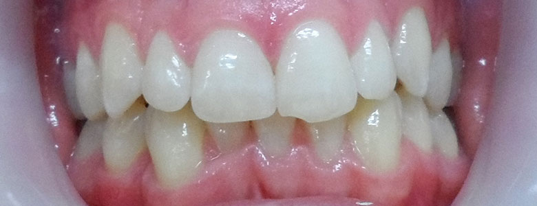 Before Clear Aligners