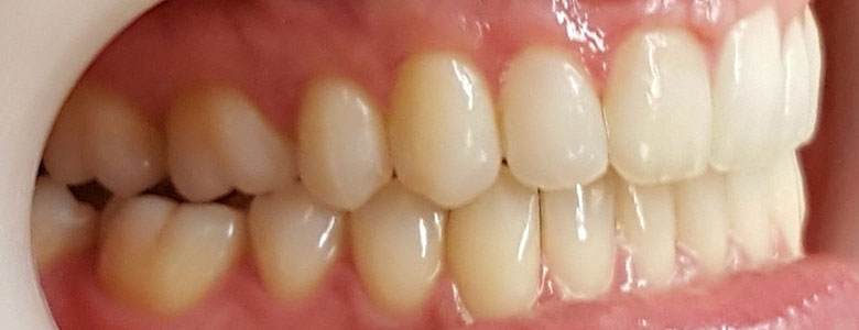 Before Clear Aligners