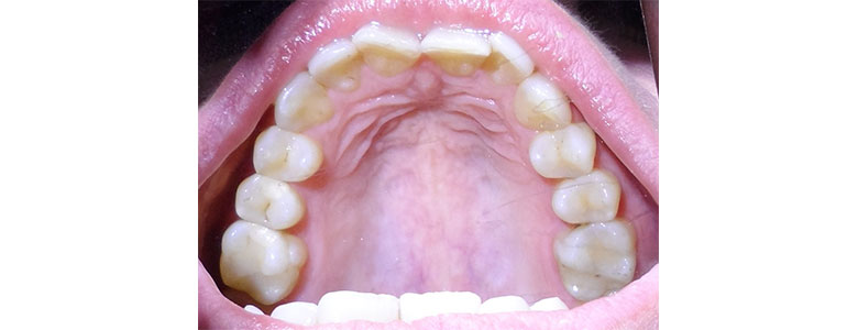 After Clear Aligners