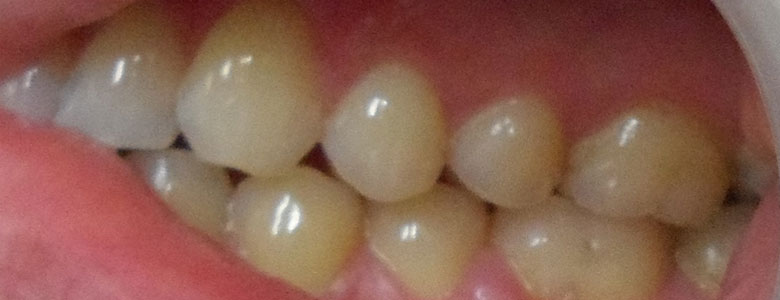 After Clear Aligners